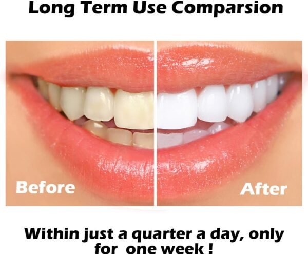 Glory Smile Teeth Whitening Kit with LED Light